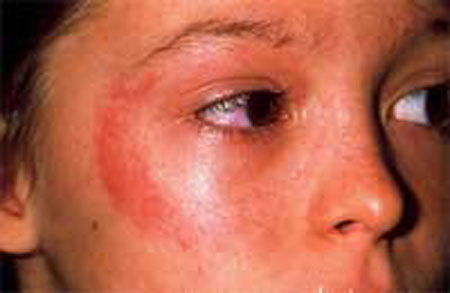 Аллергия на солнце: симптомы