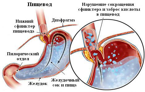 Рефлюкс эзофагит: лечение