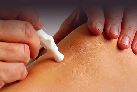 Эффективный крем от рубцов и шрамов