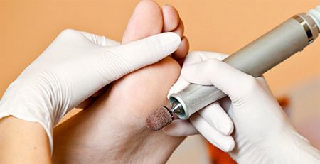 Как безболезненно убрать мозоли на ногах