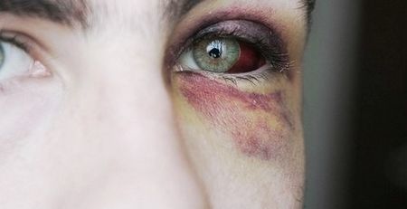 Как быстро избавиться от синяка, чтобы не осталось и следа