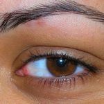 Опухло верхнее веко ― причины и способы лечения