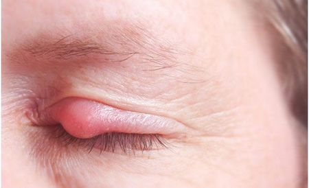 Опухло верхнее веко ― причины и способы лечения