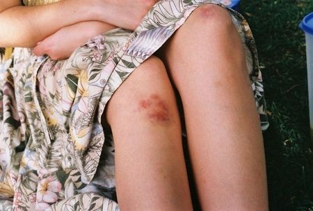 Откуда они – синяки на ногах без причины?