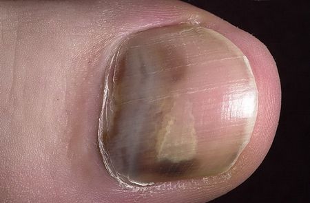 Откуда они – синяки на ногах без причины?