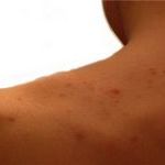 Прыщи на плечах и спине: несколько слов о неприятной проблеме