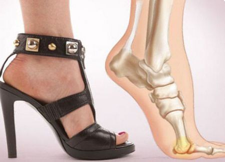 Шишка на стопе – что это такое и как с этим бороться