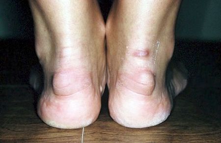 Шишка на стопе – что это такое и как с этим бороться