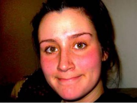 Стоит ли лечить покраснение на щеках у взрослого человека