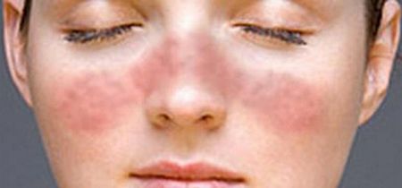 Стоит ли лечить покраснение на щеках у взрослого человека