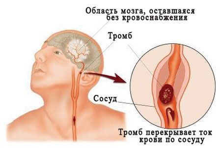 Как делать массаж руки после инсульта