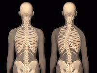 Массаж при сколиозе