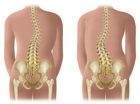 Массаж при сколиозе