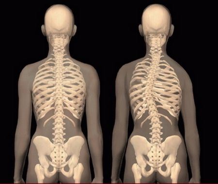 Массаж при сколиозе у детей