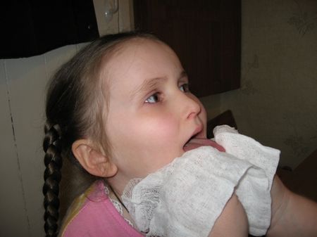 Зондовый логопедический массаж Зондовый логопедический массаж