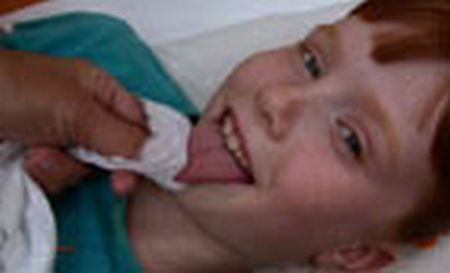 Зондовый логопедический массаж Зондовый логопедический массаж