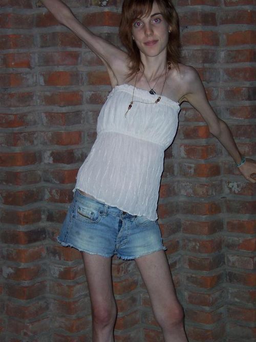 Анорексия: истории из жизни. Фото анорексичек