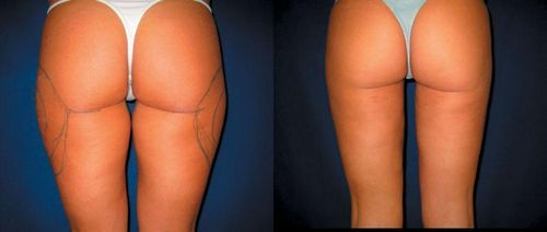 Лазерная липосакция