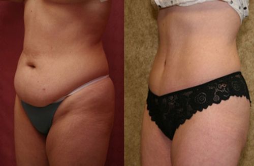 Лазерная липосакция