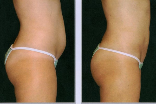 Кавитация или процедура ультразвуковой липоксации