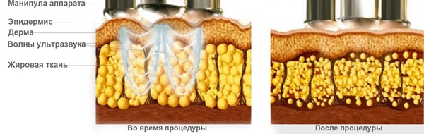 Ультразвуковая кавитация - что это такое