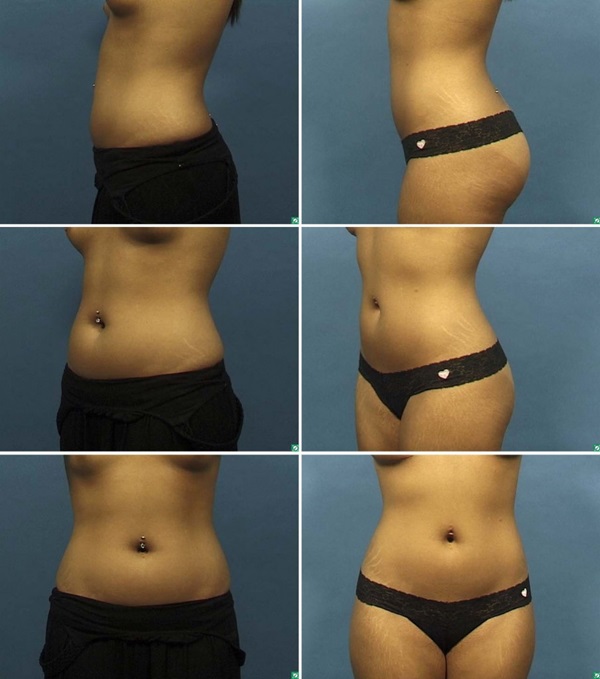 Ультразвуковая кавитация - что это такое