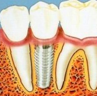 Протезирование зубов