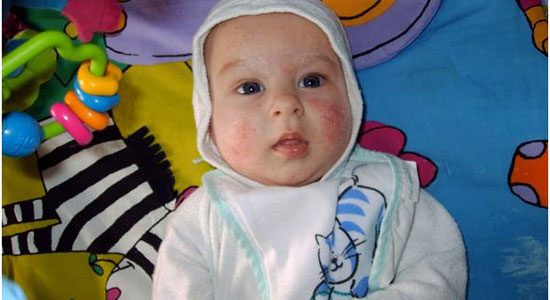 Аллергия на белок коровьего молока у ребенка в раннем возрасте.