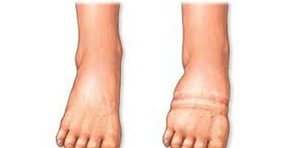 Как вывести воду из организма для похудения